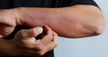 tratamiento hongos en la piel